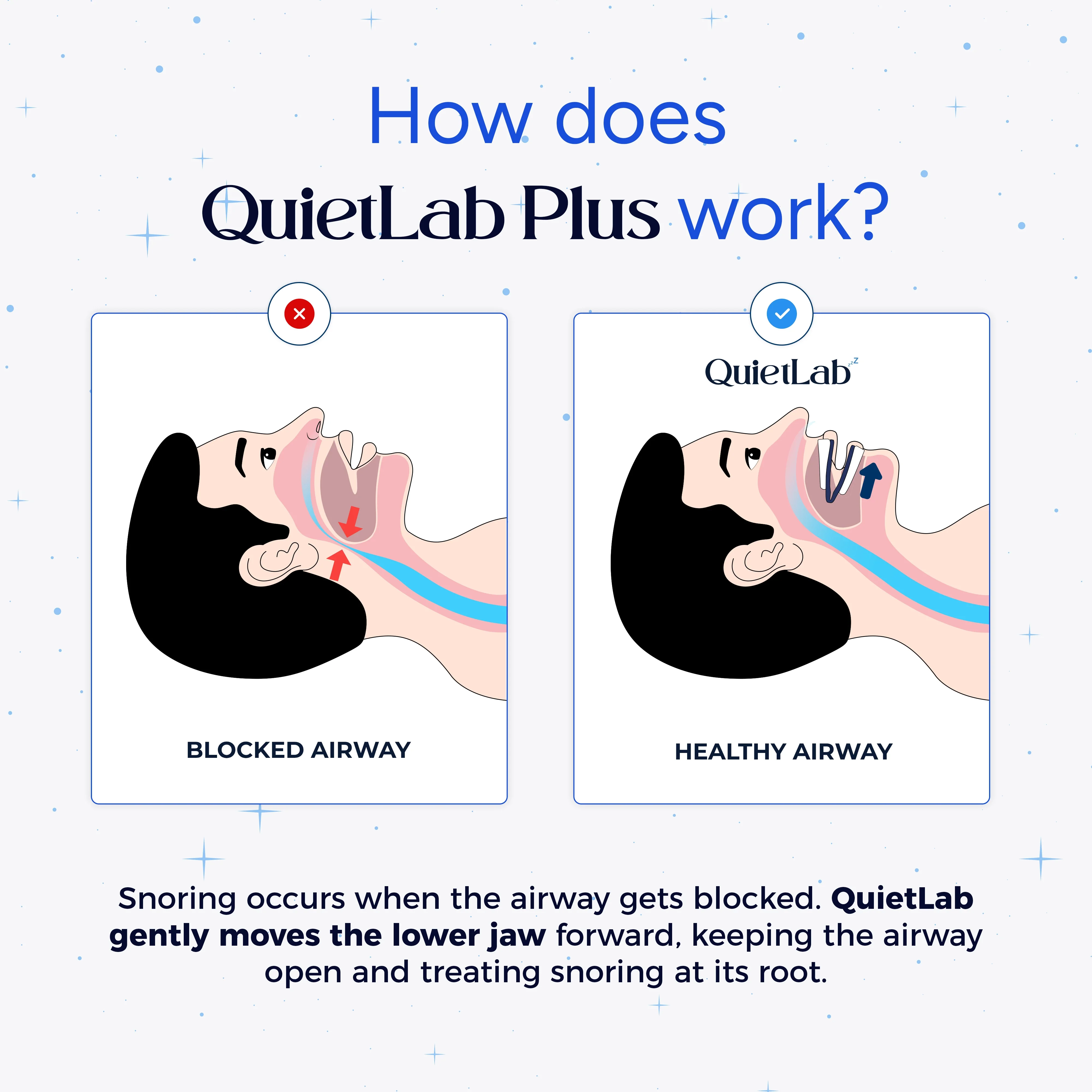 Premium QuietLab Plus Adjustable Anti-Snoring Mouthpiece - Image 5
